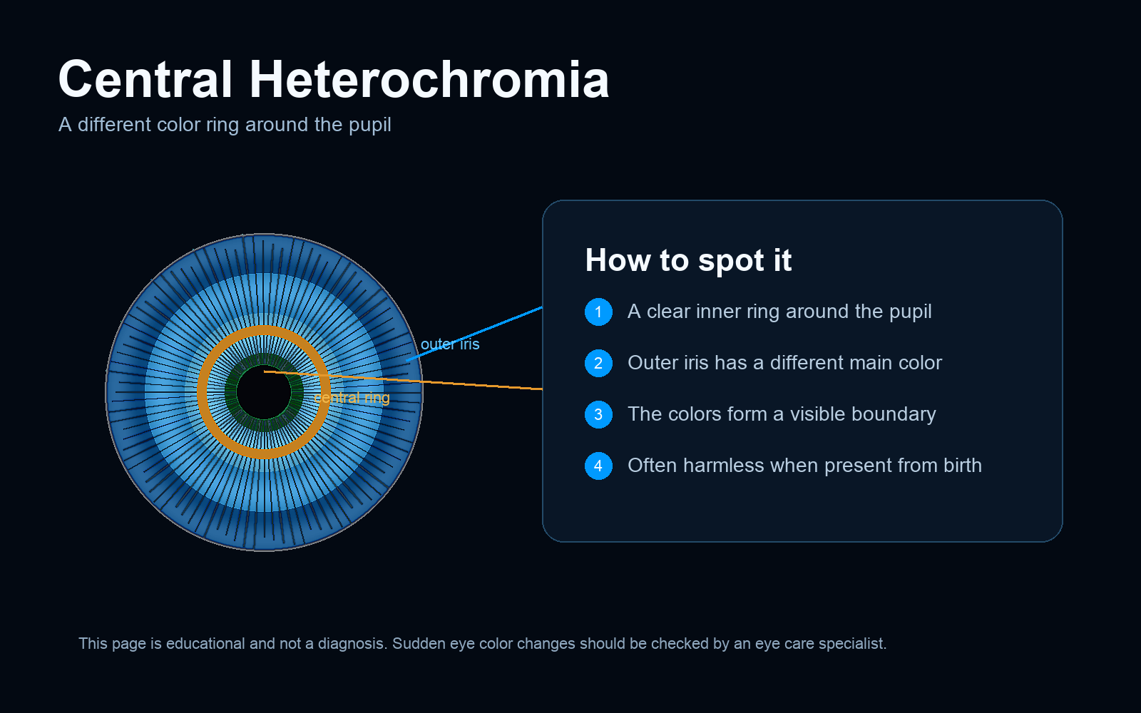 Central heterochromia eye diagram showing a different color ring around the pupil